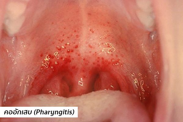 pharyngitis-5