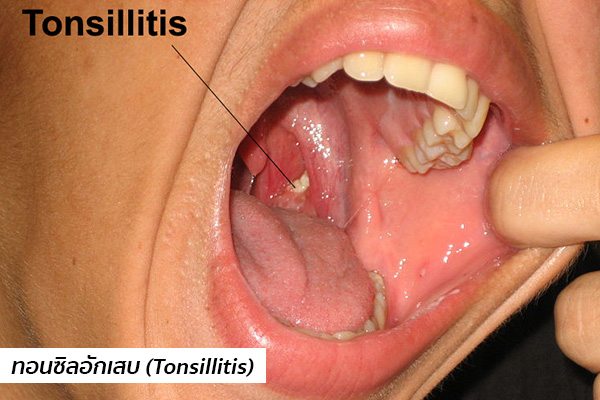อาการต่อมทอนซิลอักเสบ