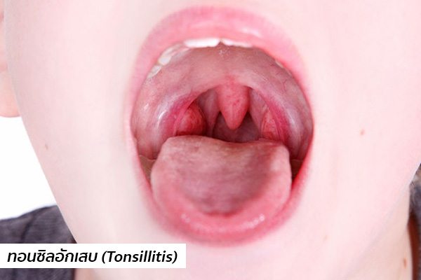 อาการทอนซิลอักเสบ