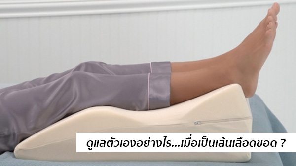 แก้เส้นเลือดขอด