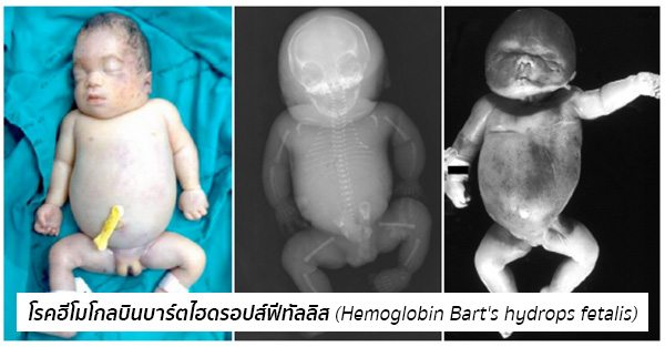โรคฮีโมโกลบินบาร์ตไฮดรอปส์ฟีทัลลิส