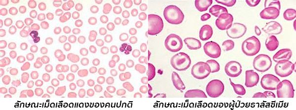 โรคโลหิตจางธาลัสซีเมีย