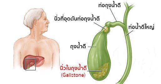 นิ่วในถุงน้ําดี (Gallstone) อาการ สาเหตุ การรักษานิ่วในถุงน้ำดี 7 วิธี !!