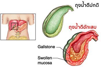 cholecystitis คือ