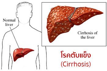 cirrhosisคือ