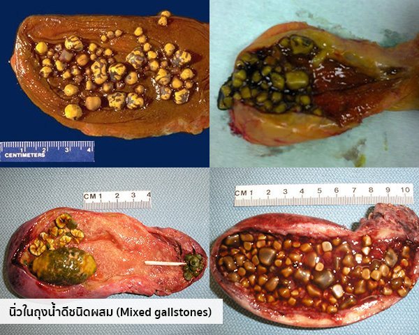 Gallstone คือ