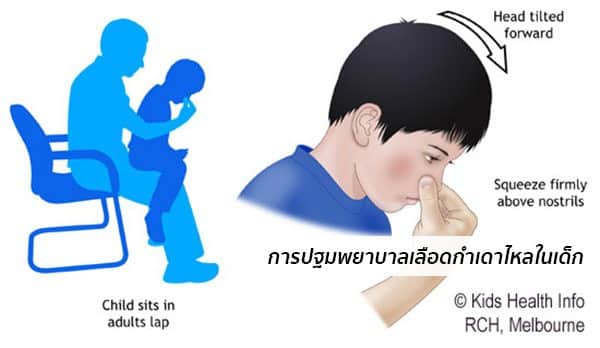 การปฐมพยาบาลเลือดกำเดาไหล