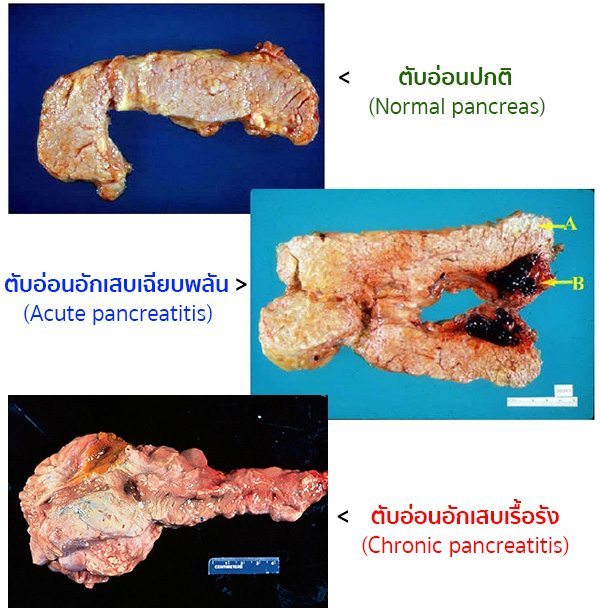 ตับอ่อนอักเสบ