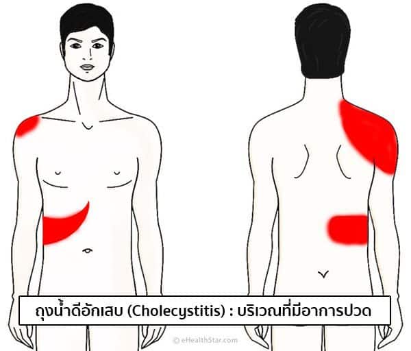 ถุงน้ำดีอักเสบ