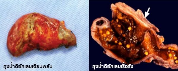 ถุงน้ำดีอักเสบอาการ