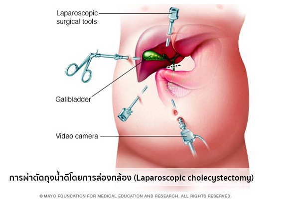 ผ่าตัดนิ่วในถุงน้ำดี