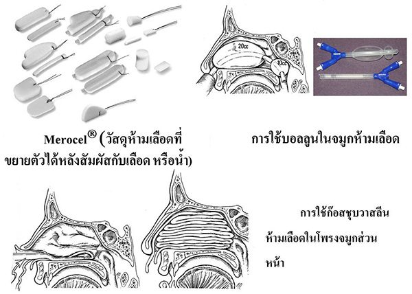 หยุดเลือดกำเดาไหล