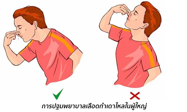 ห้ามเลือดกำเดาไหล
