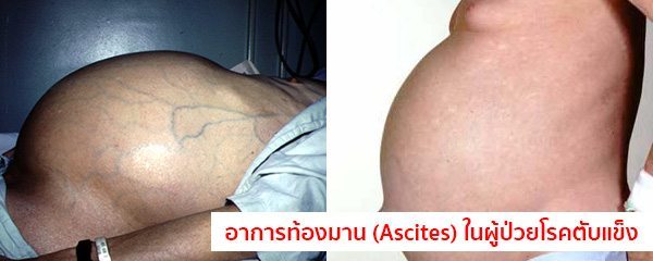 อาการของโรคตับแข็งระยะสุดท้าย