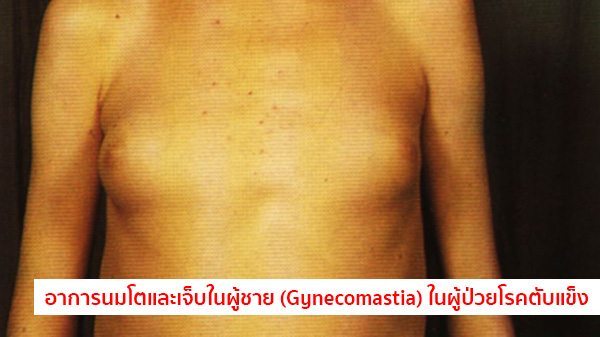 อาการตับแข็ง