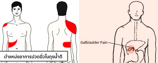 อาการนิ่วในถุงน้ำดี