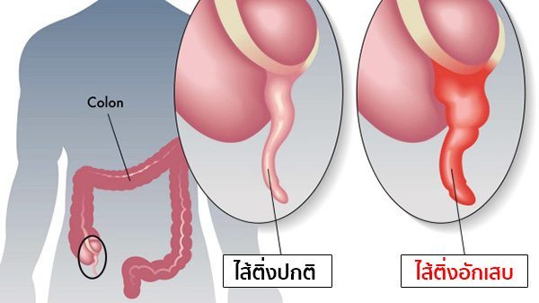 อาการปวดท้องไส้ติ่ง