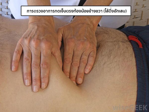อาการปวดไส้ติ่ง