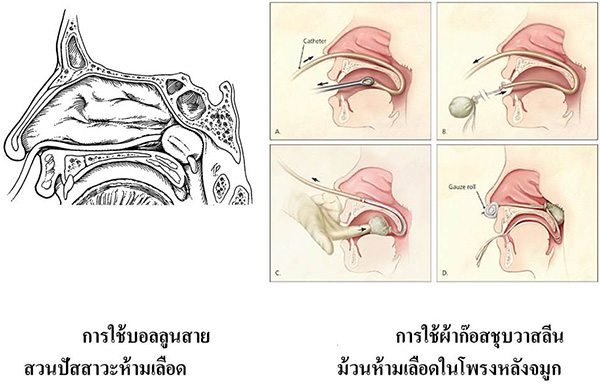 แก้เลือดกำเดาไหล