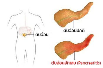 โรคตับอ่อนอักเสบ