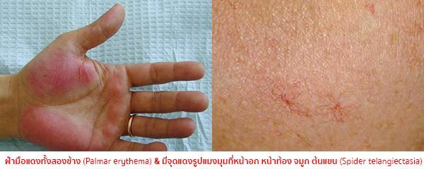 โรคตับแข็งระยะแรก