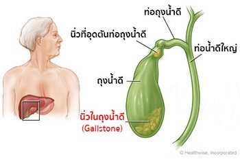 โรคนิ่วในถุงน้ำดี