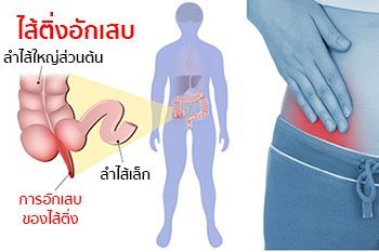 โรคไส้ติ่งอักเสบ