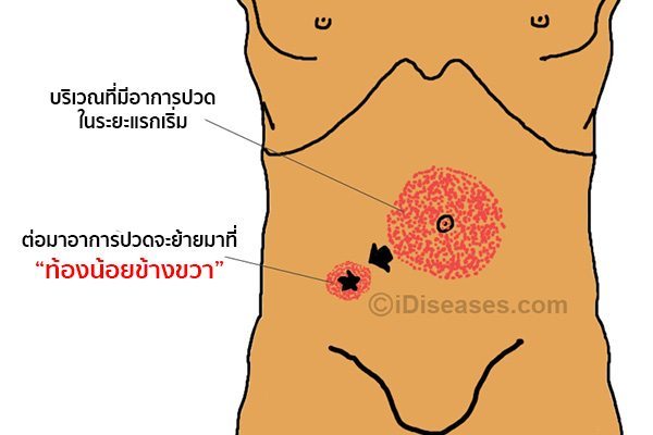 ไส้ติ่งปวดข้างไหน