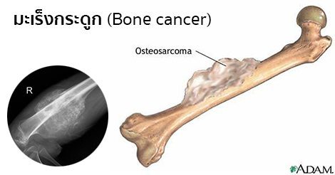 มะเร็งกระดูก (Bone cancer) อาการ & การรักษาโรคมะเร็งกระดูก 10 วิธี !