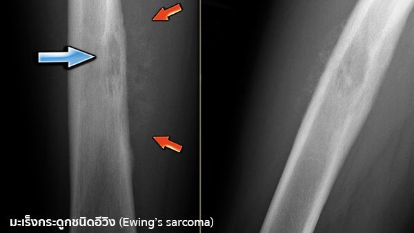 Ewing’s sarcoma คือ