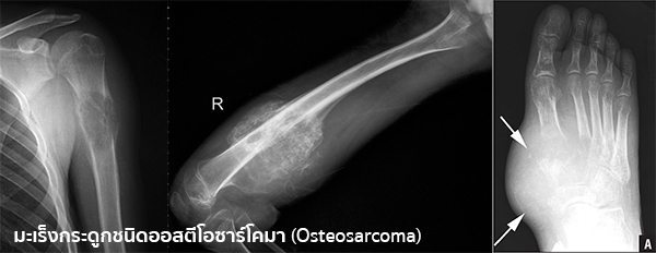 Osteosarcoma คือ