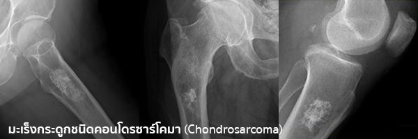 chondrosarcoma คือ