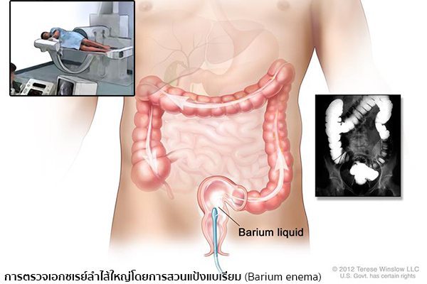 การตรวจมะเร็งลำไส้
