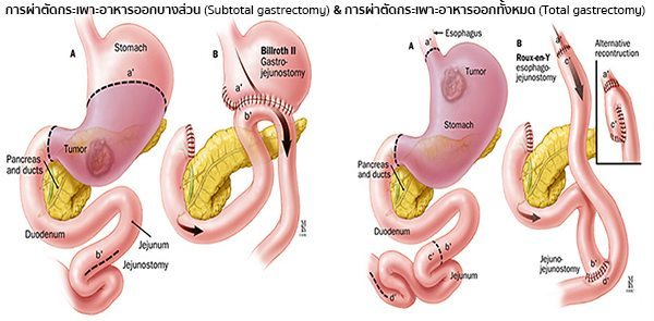 การผ่าตัดมะเร็งกระเพาะอาหาร