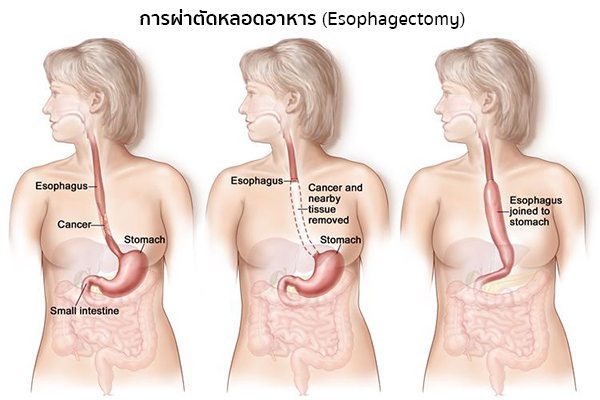 การผ่าตัดมะเร็งหลอดอาหาร