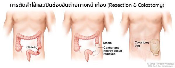 การรักษามะเร็งลําไส้ใหญ่