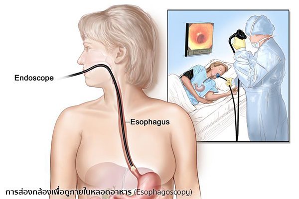 การวินิจฉัยโรคมะเร็งหลอดอาหาร
