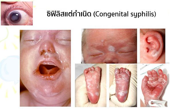 ซิฟิลิสแต่กำเนิด