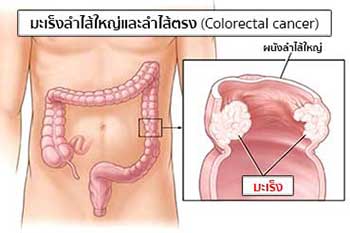 มะเร็งลําไส้ใหญ่