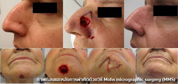 วิธีรักษามะเร็งผิวหนัง
