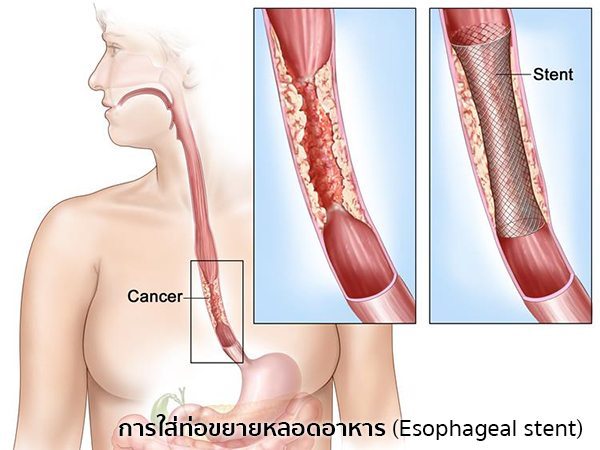 วิธีรักษามะเร็งหลอดอาหาร
