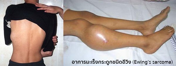 อาการของมะเร็งกระดูก