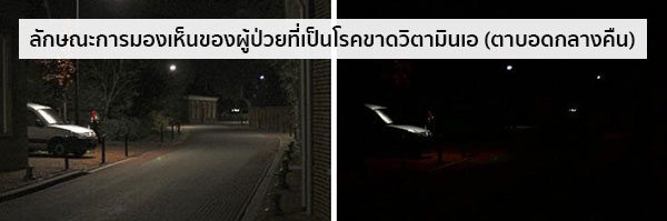 อาการโรคขาดวิตามินเอ