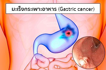 โรคมะเร็งกระเพาะอาหาร