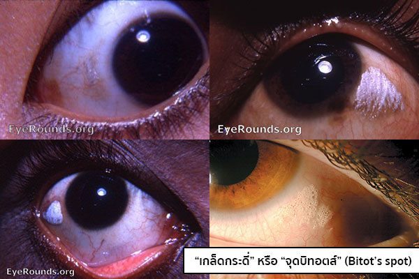 โรคเกล็ดกระดี่ขึ้นตา