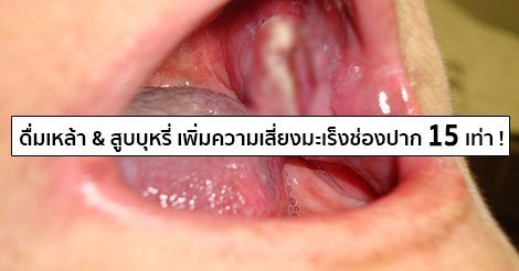 มะเร็งช่องปาก (Oral cancer) อาการ สาเหตุ การรักษามะเร็งในช่องปาก 5 วิธี !