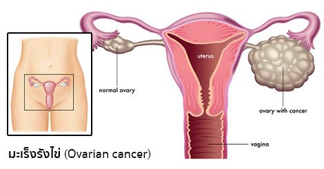 มะเร็งรังไข่ (Ovarian cancer) อาการ สาเหตุ การรักษาโรคมะเร็งรังไข่ 5 วิธี !