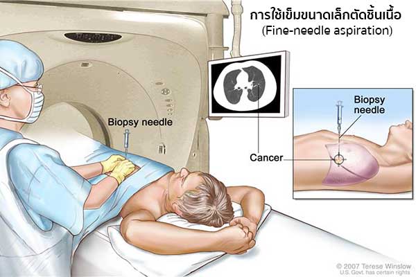 การตรวจวินิจฉัยโรคมะเร็งปอด