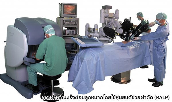 ผ่าตัดมะเร็งต่อมลูกหมาก