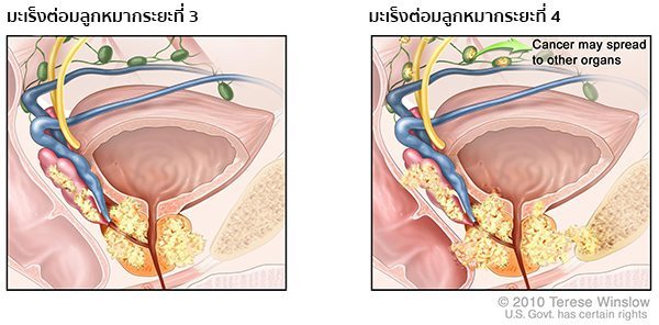 มะเร็งต่อมลูกหมากระยะสุดท้าย